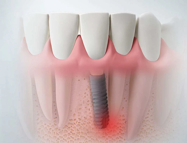 Biến chứng trồng răng Implant và những điều cần lưu ý
