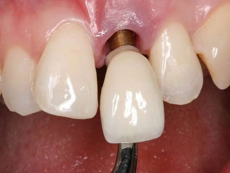 Biến chứng trồng răng Implant sau thời gian lành bệnh