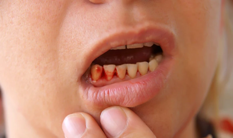 Các yếu tố gây biến chứng trồng răng Implant