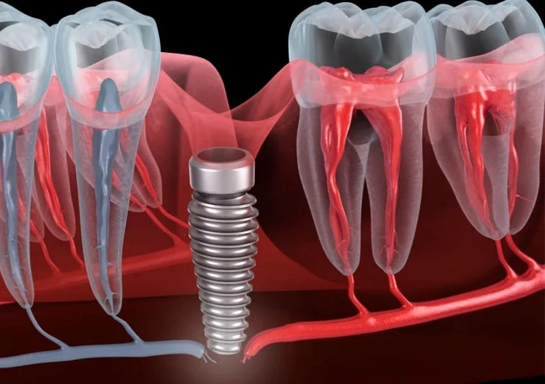 Lựa chọn nha khoa uy tín để hạn chế biến chứng trồng răng Implant