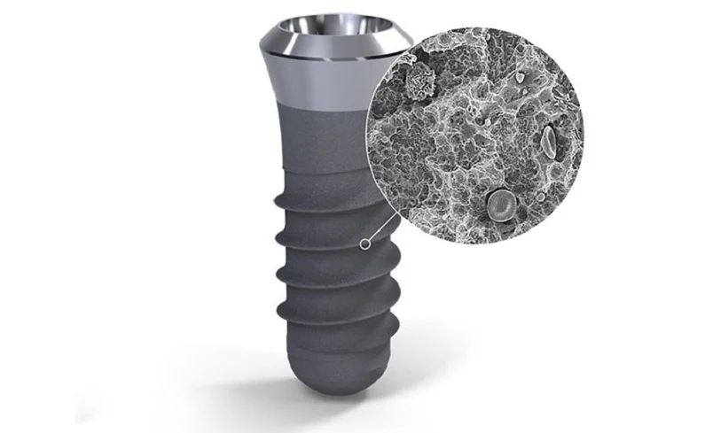 Trụ implant sợi carbon