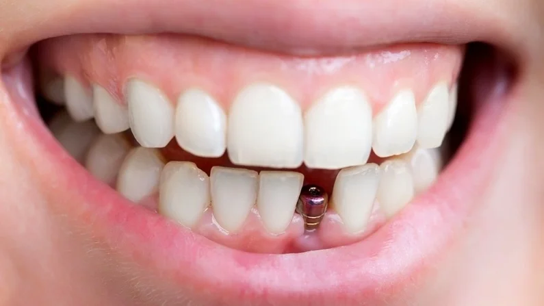 Nhổ răng bao lâu thì mới có thể trồng răng Implant?