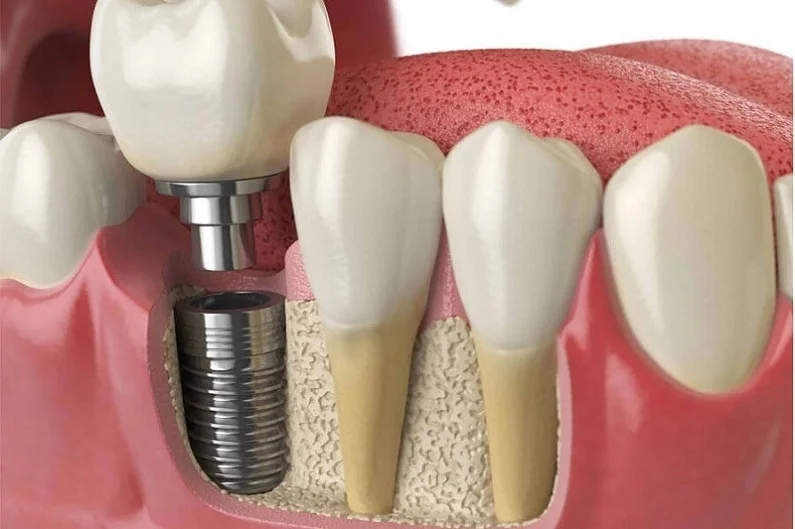 Nhổ răng bao lâu thì mới có thể trồng răng Implant?