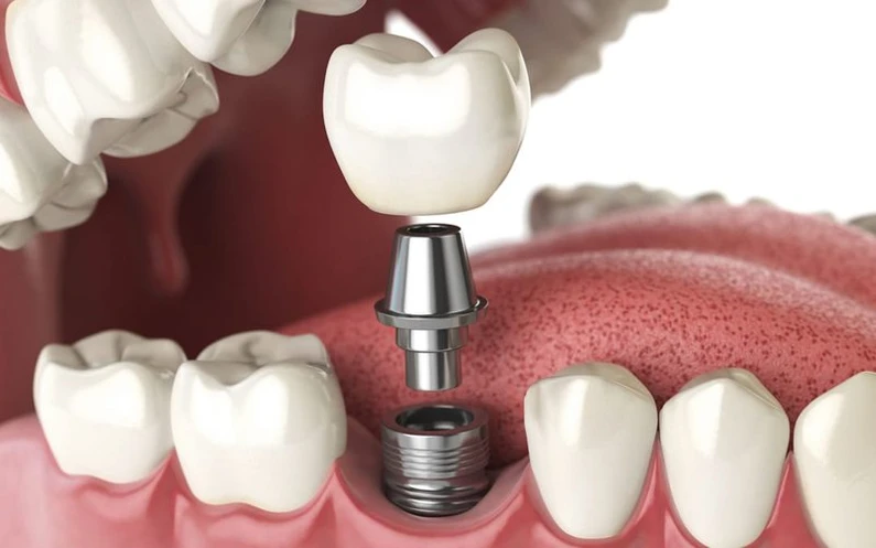 Quy trình trồng răng Implant tại Thế Giới Implant