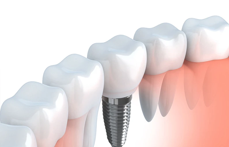 Quy trình trồng răng Implant tại Thế Giới Implant