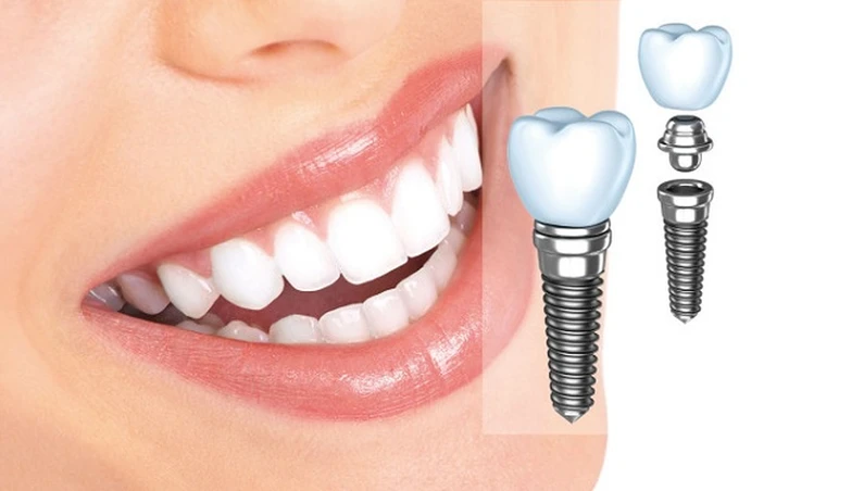 Trồng răng Implant có được bảo hiểm hỗ trợ không?