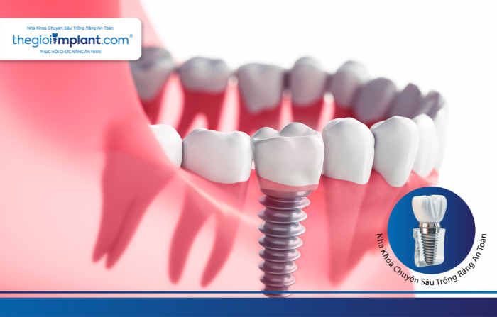 Thế Giới Implant