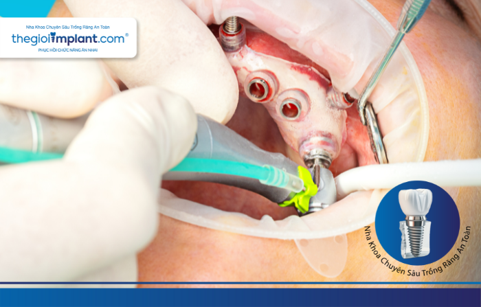 Thế Giới Implant