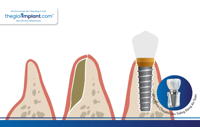 Thế Giới Implant
