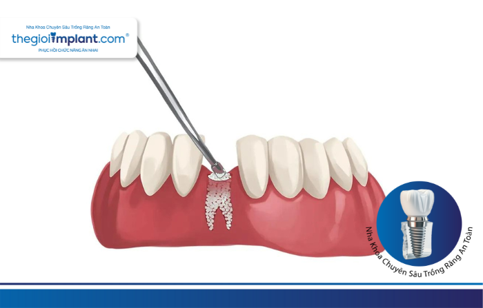 Thế Giới Implant