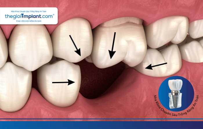 Thế Giới Implant