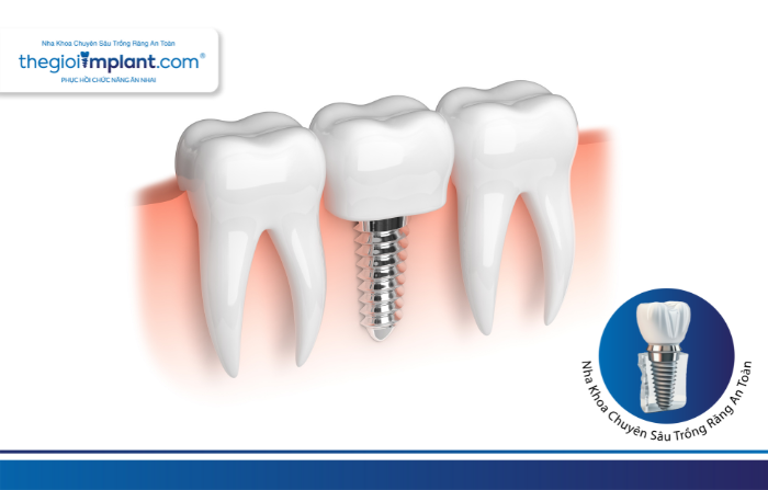 Thế Giới Implant