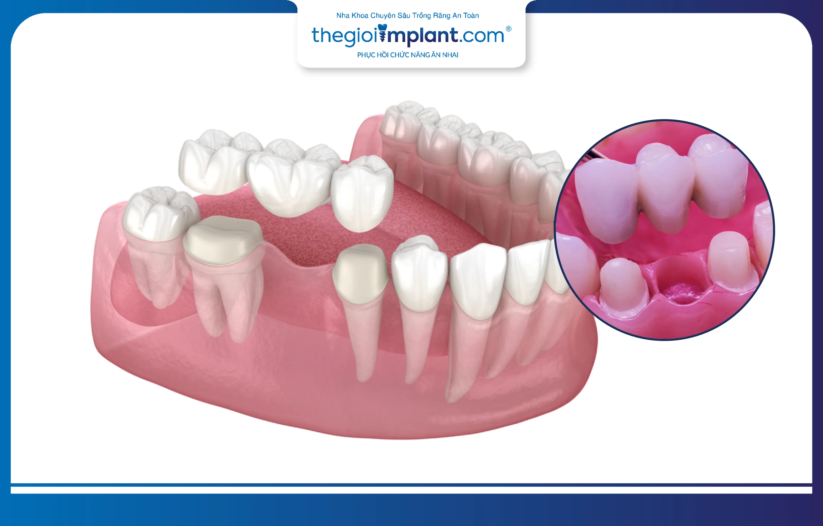 Cầu răng sứ phục hình một răng bị mất