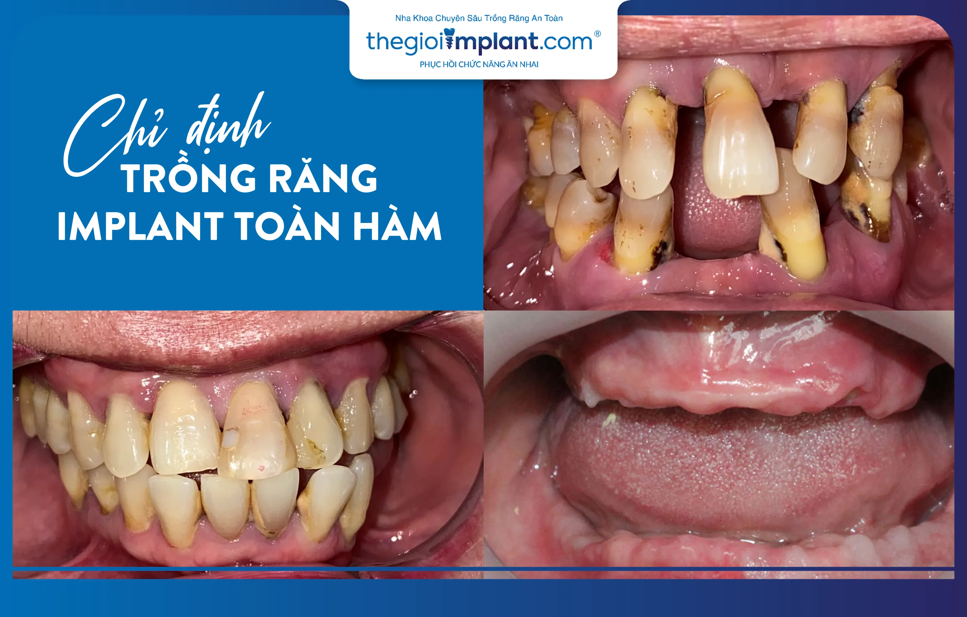 Trường hợp chỉ định trồng răng Implant toàn hàm