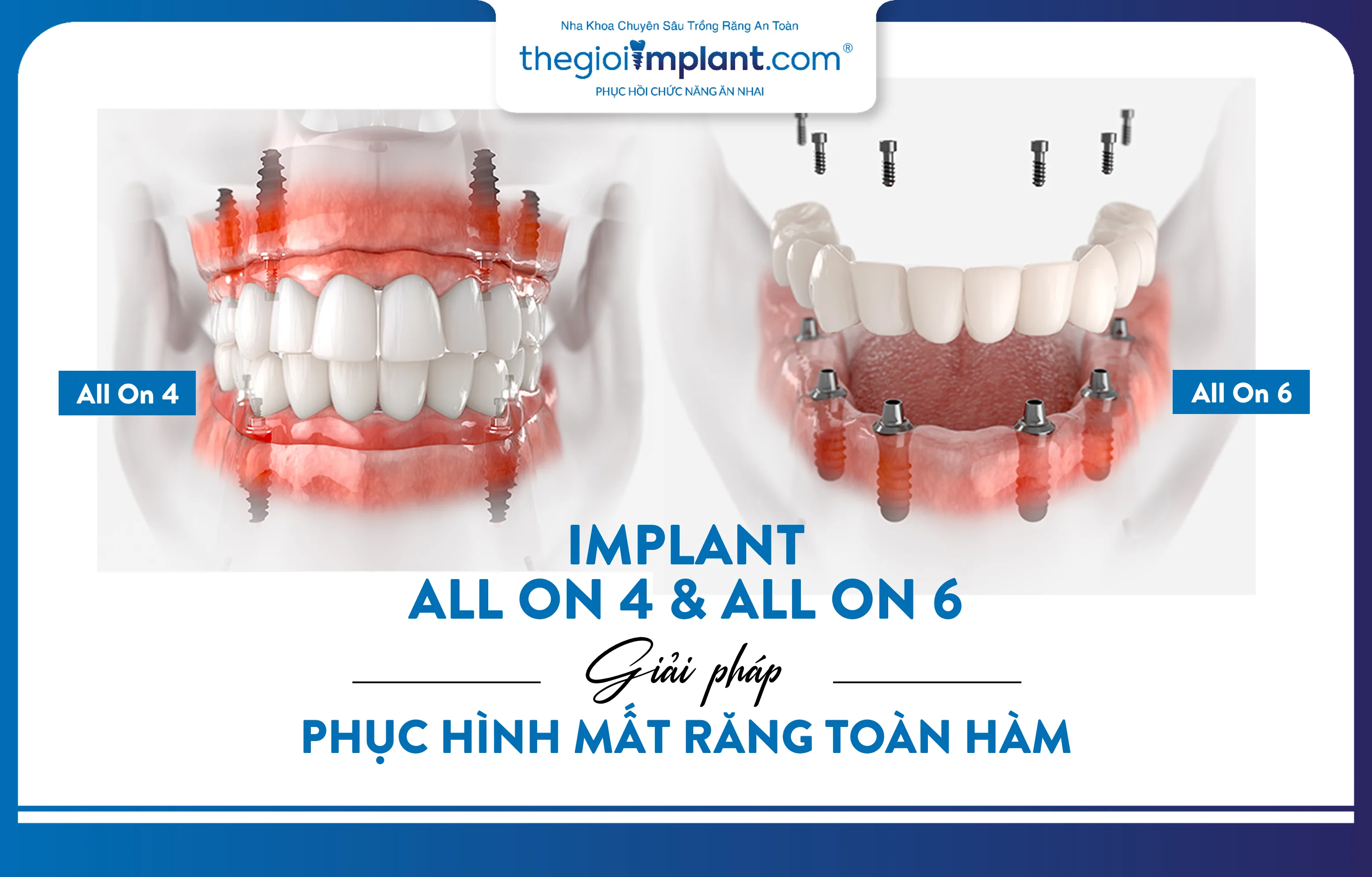 Implant All On 4 và All On 6 - giải pháp phục hình mất răng toàn hàm