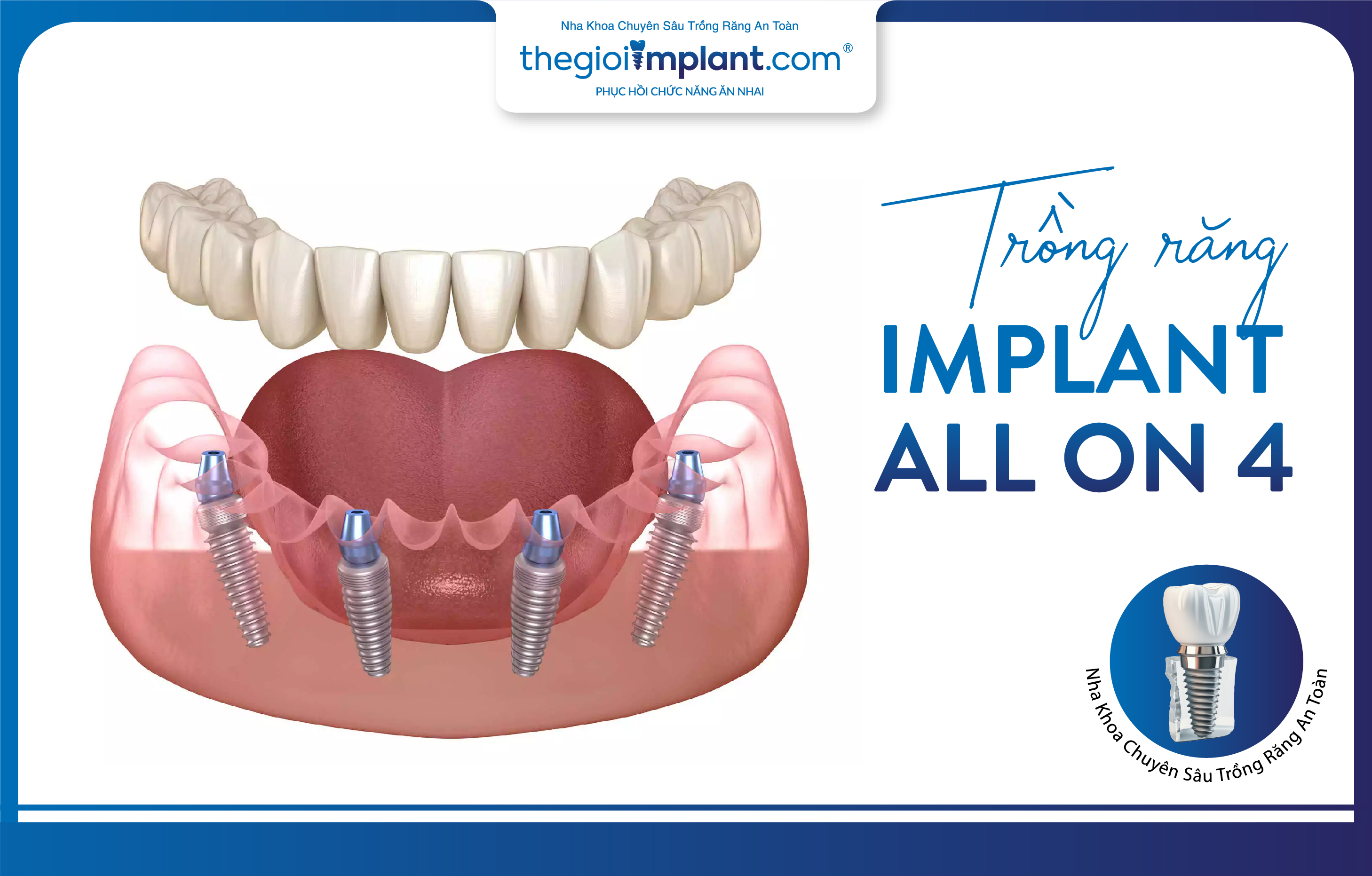 Phương pháp trồng răng Implant toàn hàm All On 4