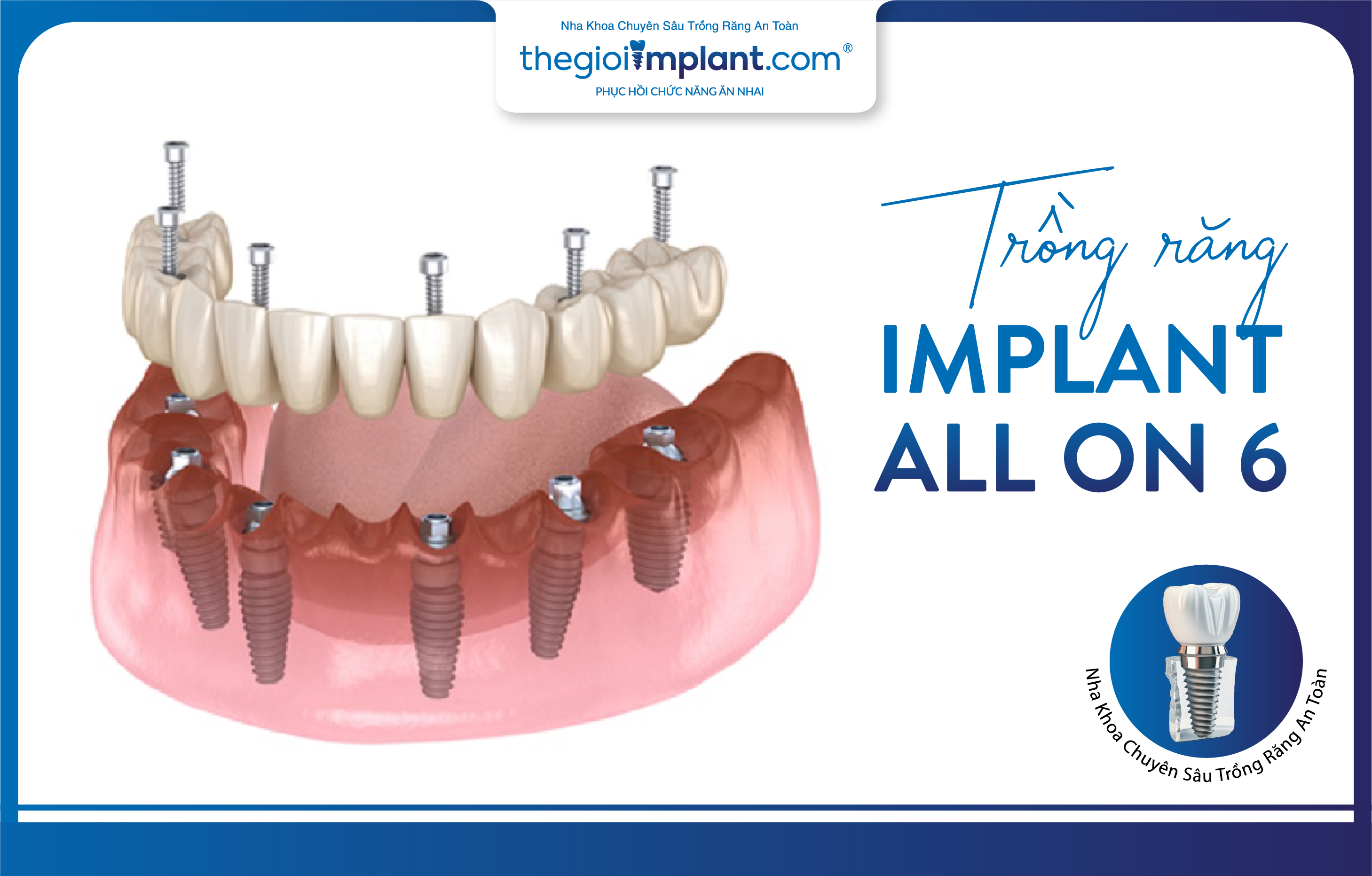 Phương pháp trồng răng Implant toàn hàm All On 6