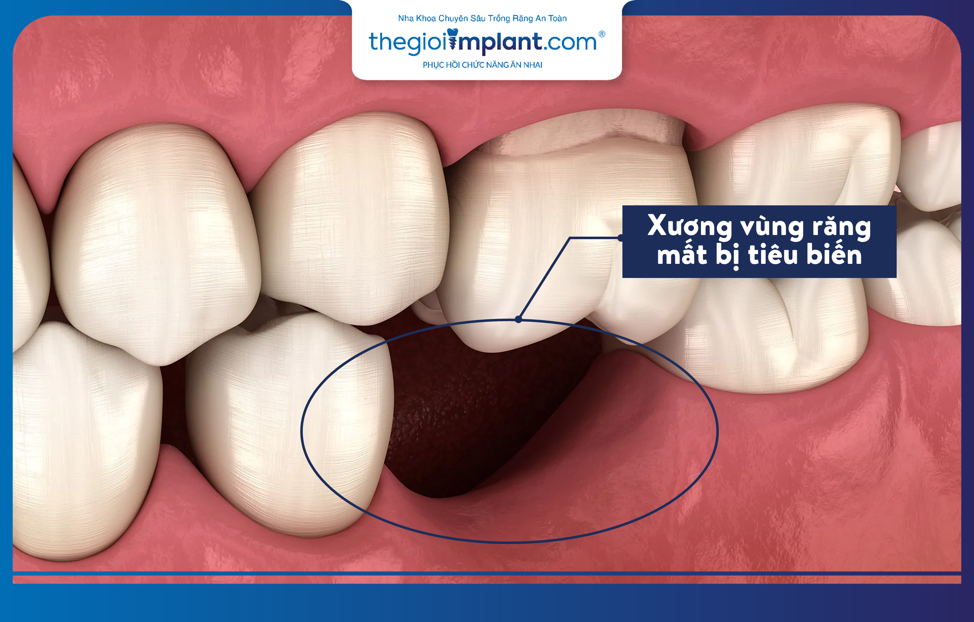 Vùng xương hàm tại vị trí mất răng lâu năm sẽ bị tiêu biến