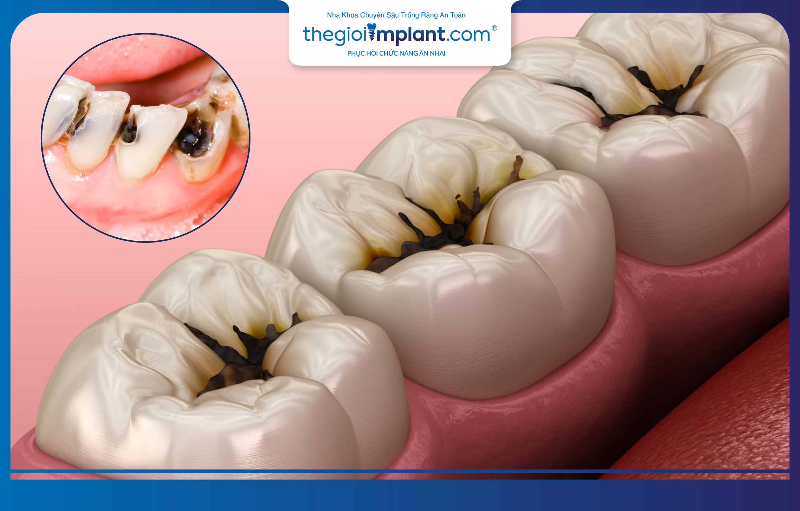 Sâu răng không điều trị kịp thời gây chết tủy dẫn đến mất răng