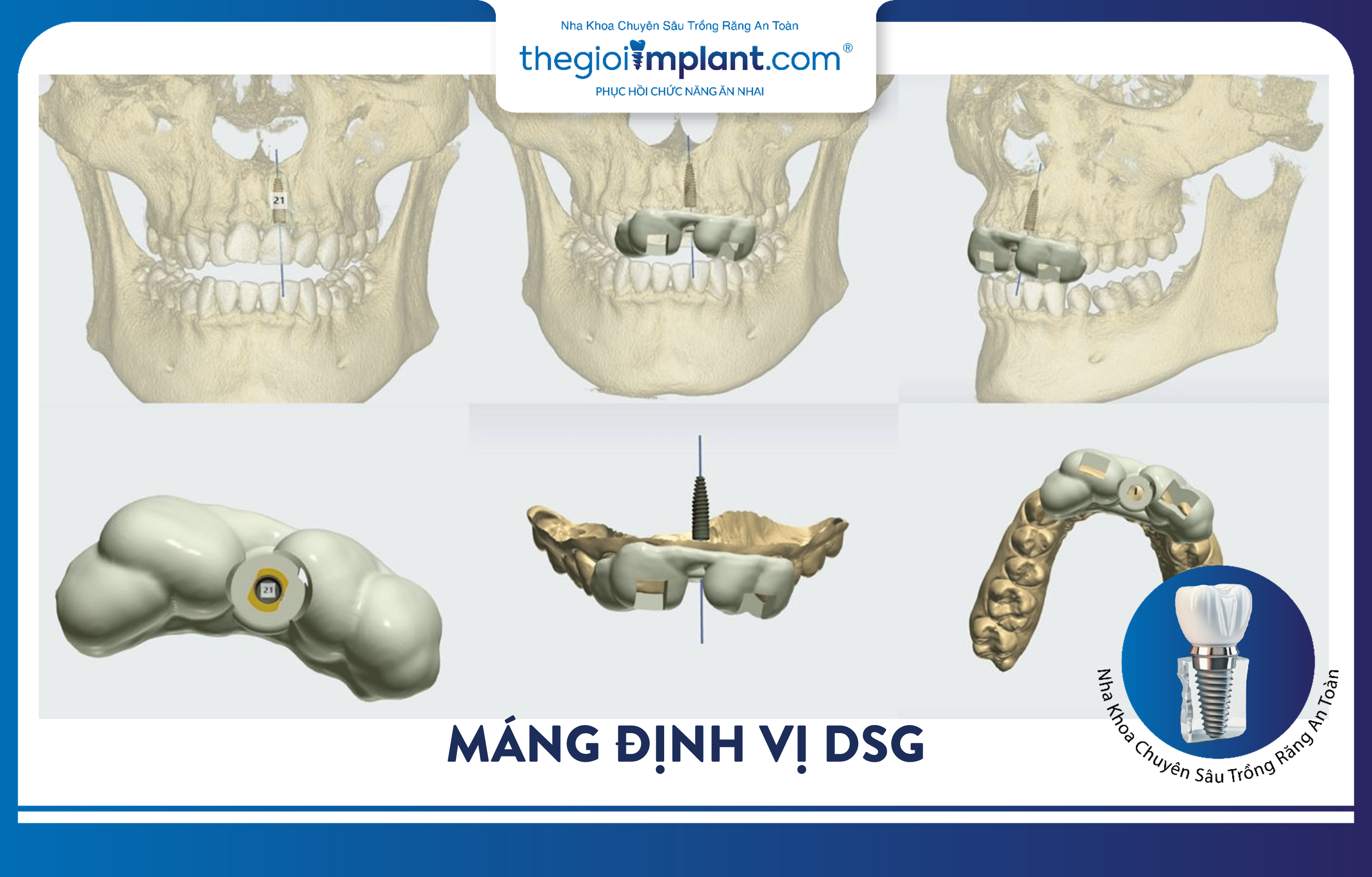 Máng định vị DSG giúp quy trình trồng răng Implant an toàn hơn