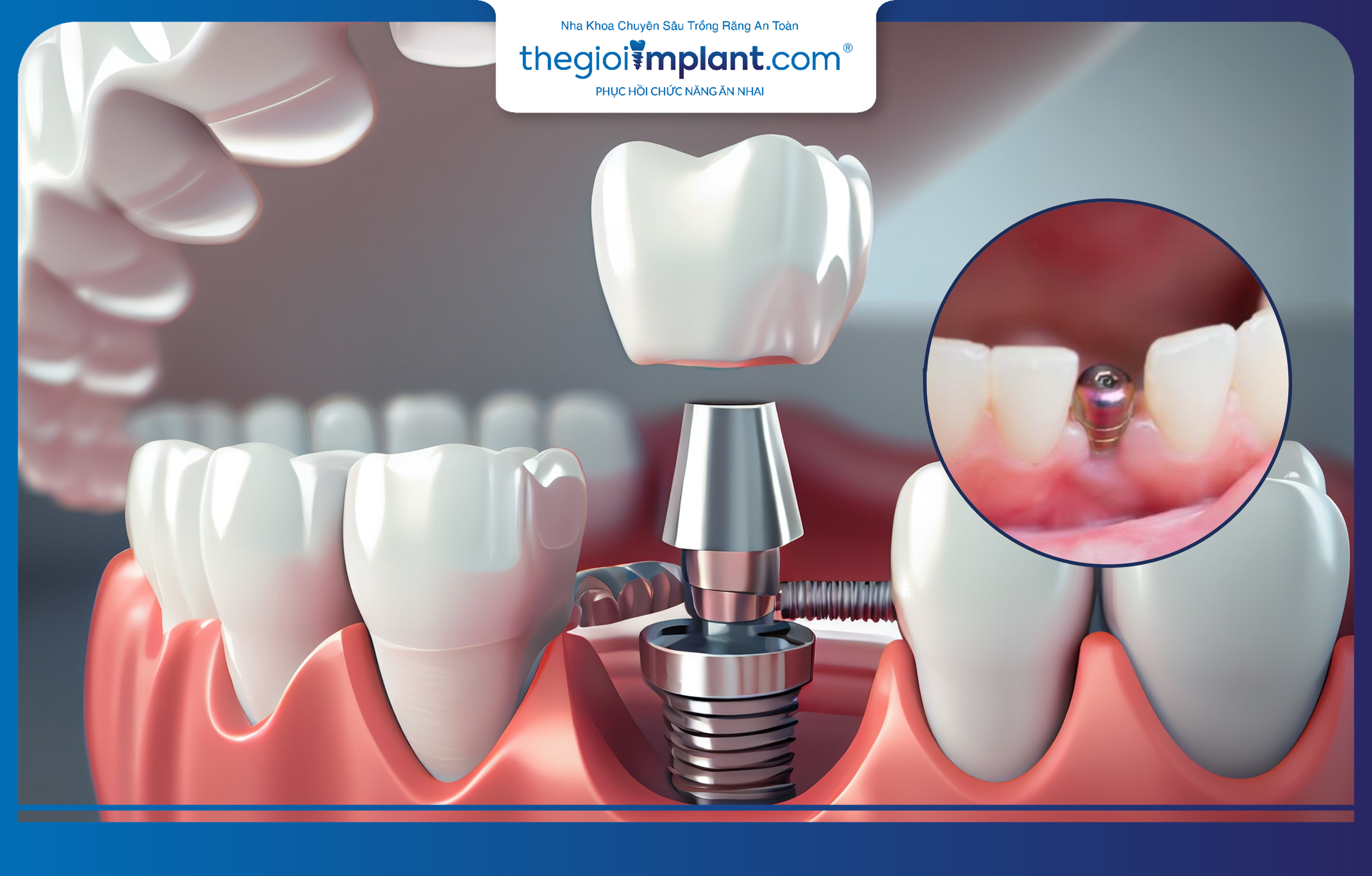 Trồng răng Implant giúp phục hình răng mất tối ưu