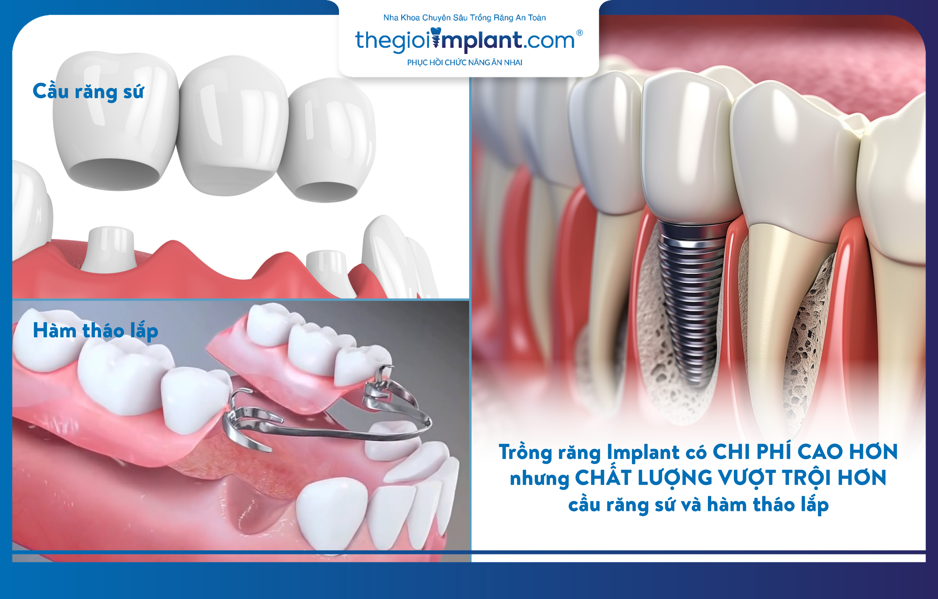 Trồng răng Implant có chi phí cao hơn nhưng chất lượng vượt trội hơn các phương pháp khác