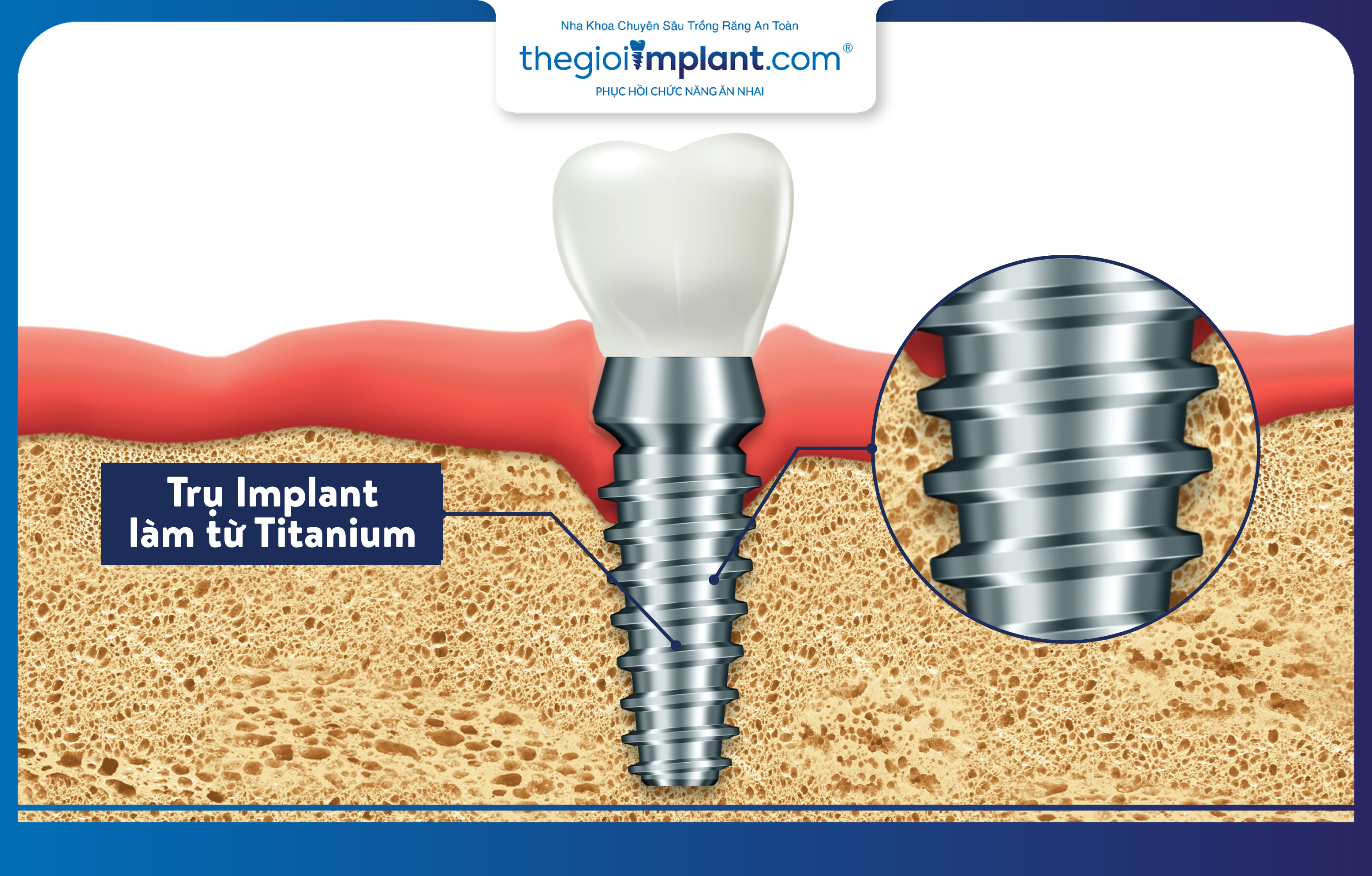 Titanium là vật liệu chế tác trụ Implant, an toàn với cơ thể