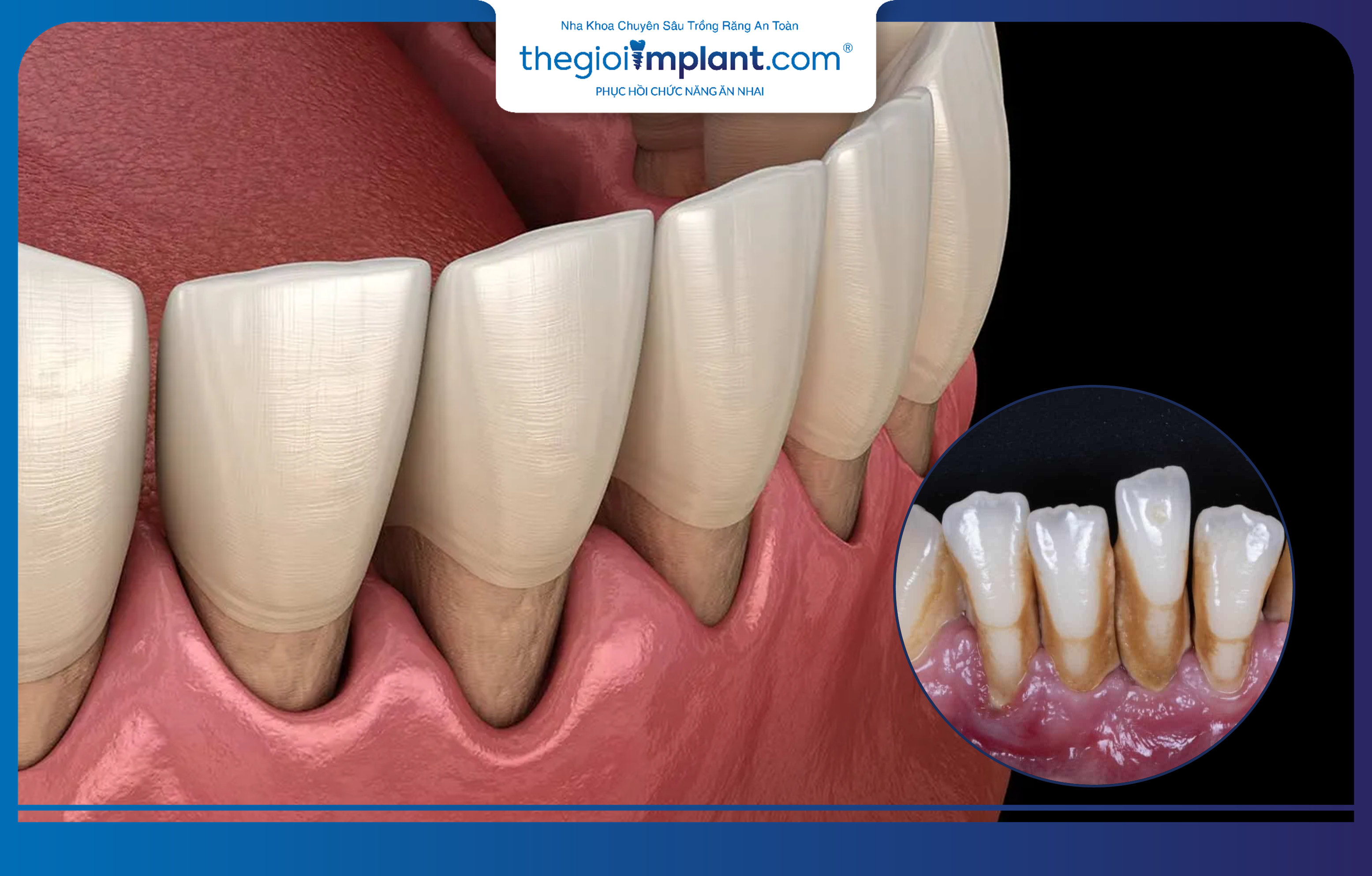 Viêm nha chu là một trong những nguyên nhân chính gây mất răng