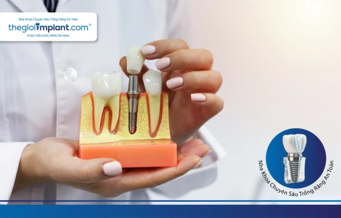 Thế Giới Implant