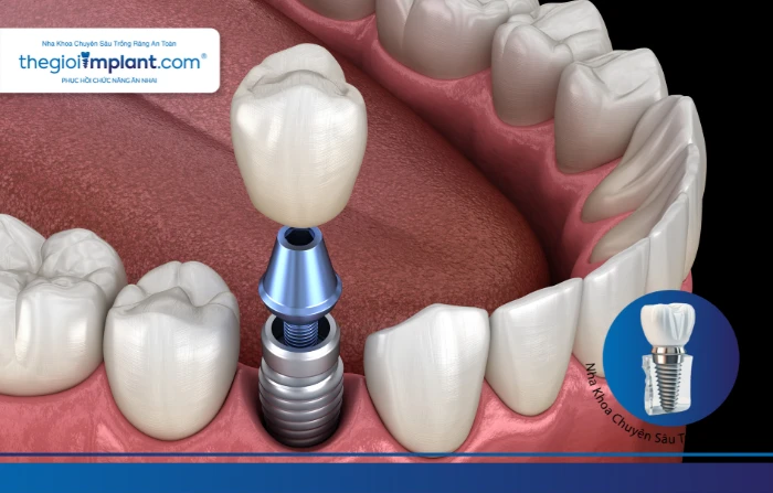 Thế Giới Implant