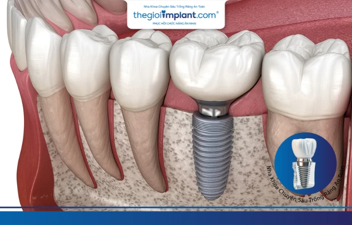 Thế Giới Implant