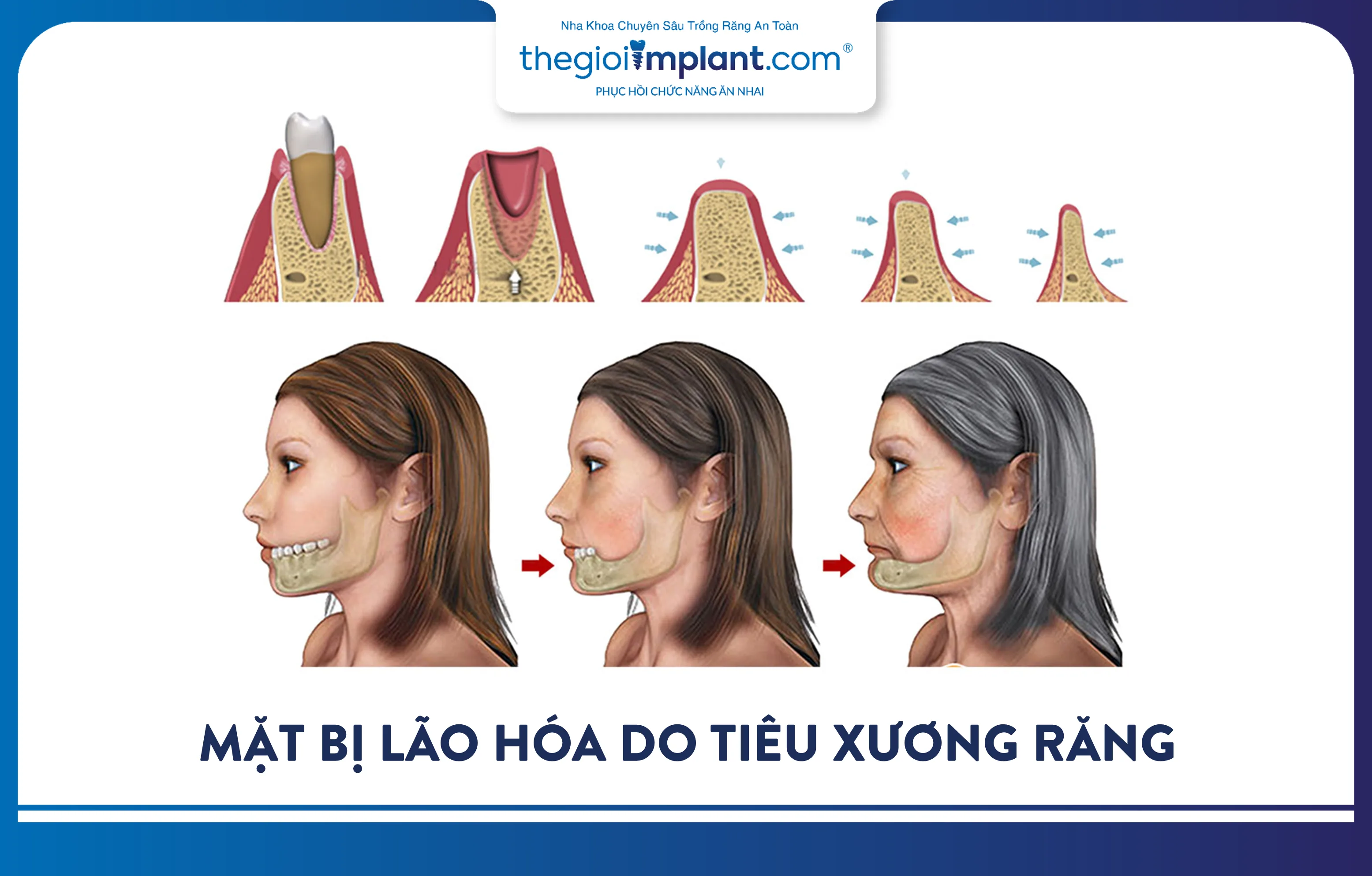 Xương hàm tiêu biến khiến gương mặt bị lão hóa