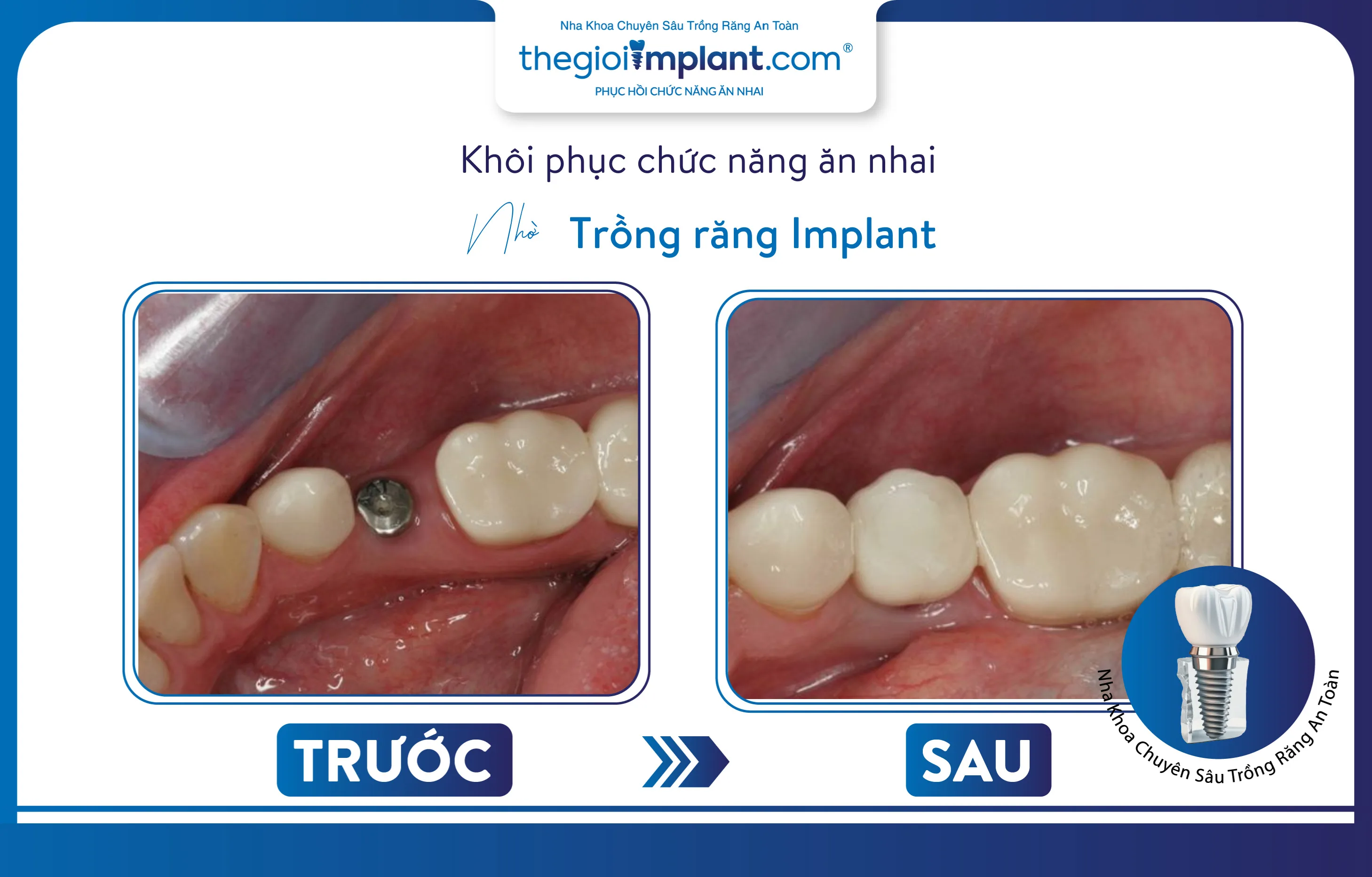 Trồng răng Implant là giải pháp phục hình mất răng hiệu quả