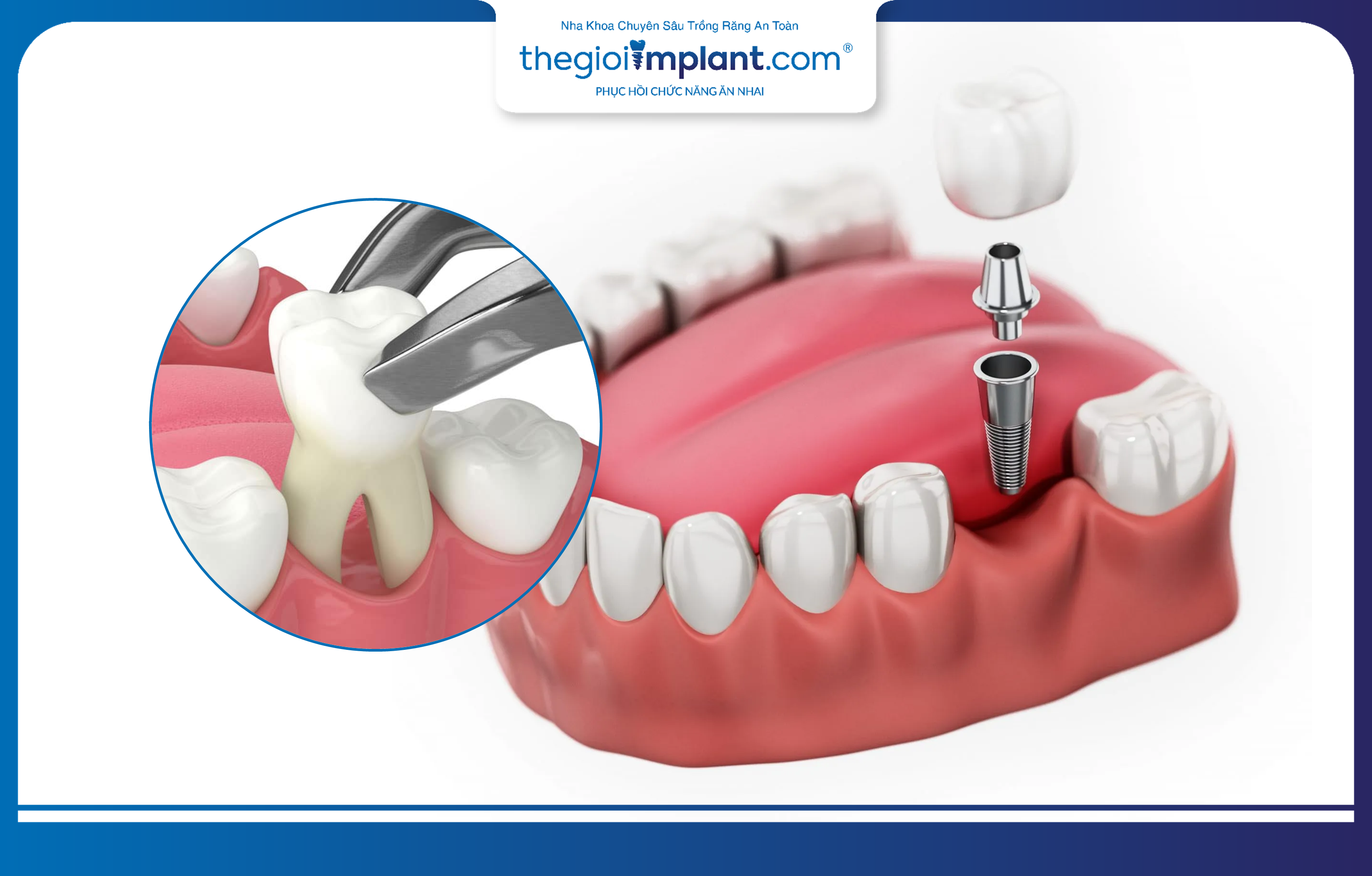 Trồng răng Implant và phục hình tức thì sau khi nhổ răng