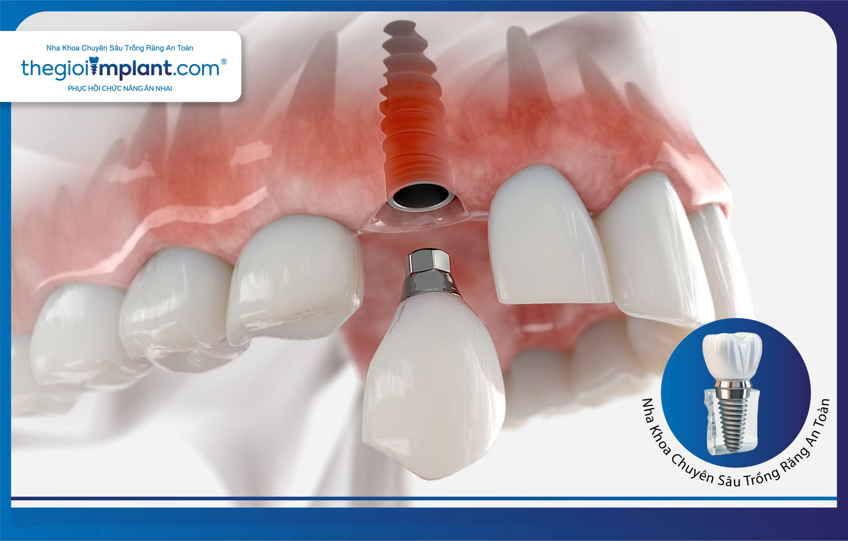 Trồng răng Implant thay thế một răng mất
