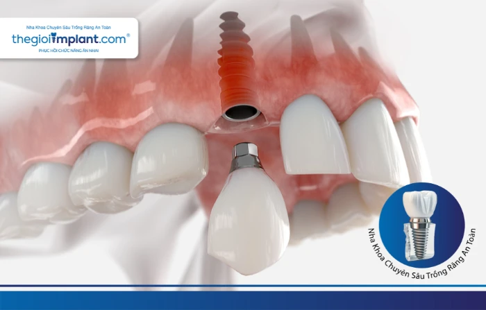 Thế Giới Implant