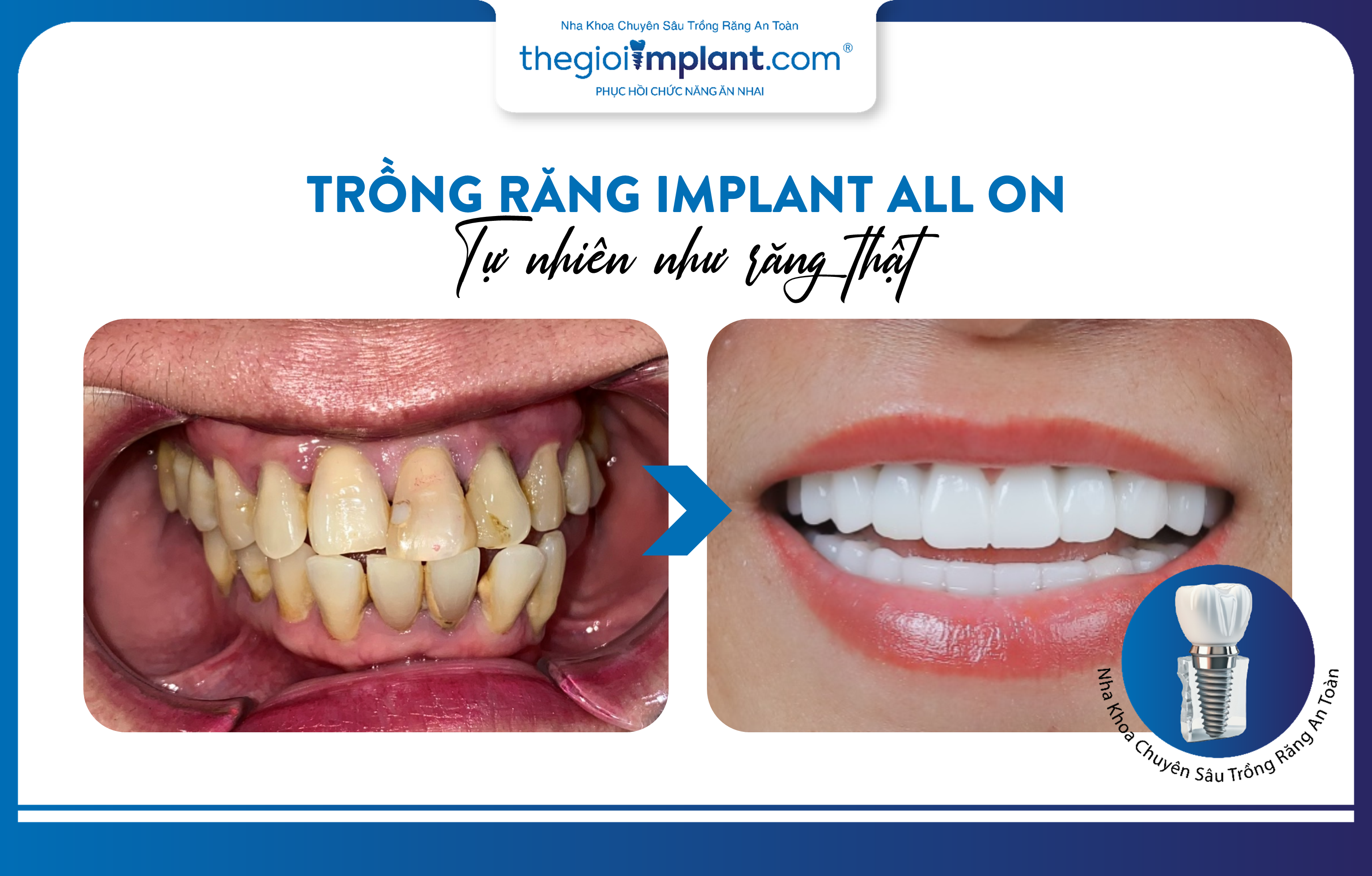 Trồng răng Implant toàn hàm All On: thẩm mỹ tự nhiên như răng thật