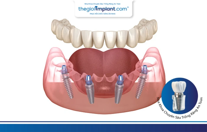 Thế Giới Implant