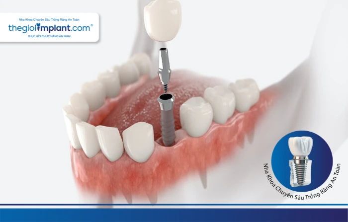 Thế Giới Implant