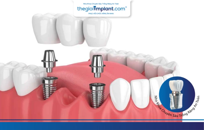 Trồng răng Implant thay thế một răng