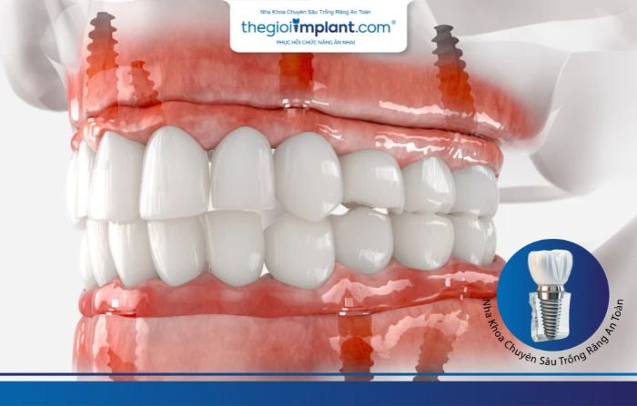 Thế Giới Implant