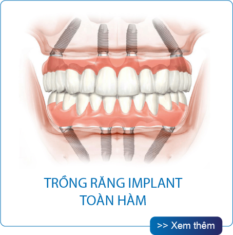 Thế Giới Implant