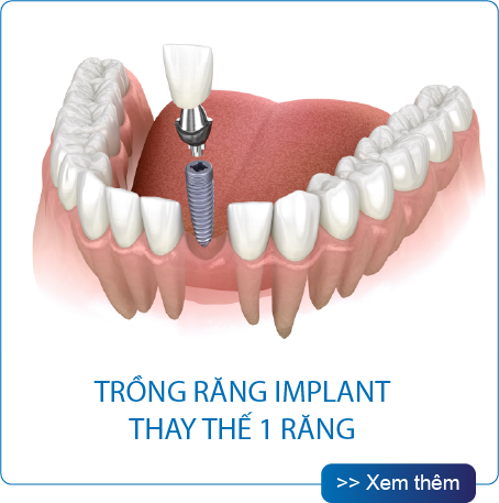 Thế Giới Implant