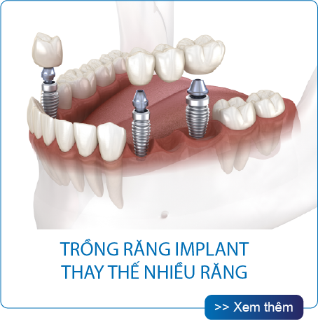 Thế Giới Implant
