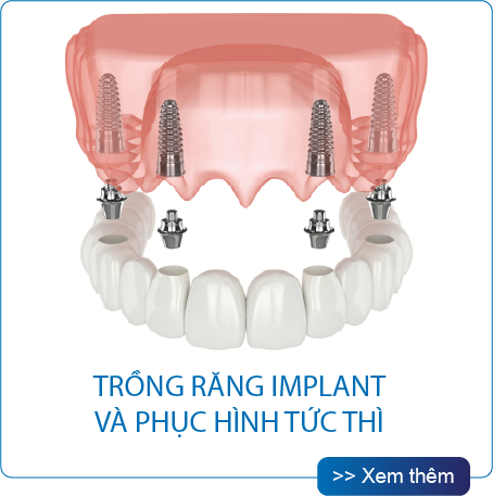 Thế Giới Implant