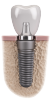 Thế Giới Implant
