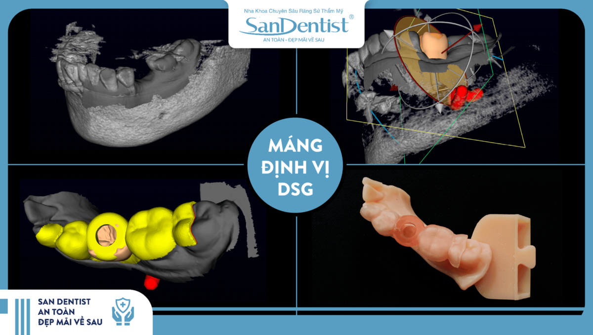 Máng định vị DSG sử dụng trong quy trình trồng răng Implant