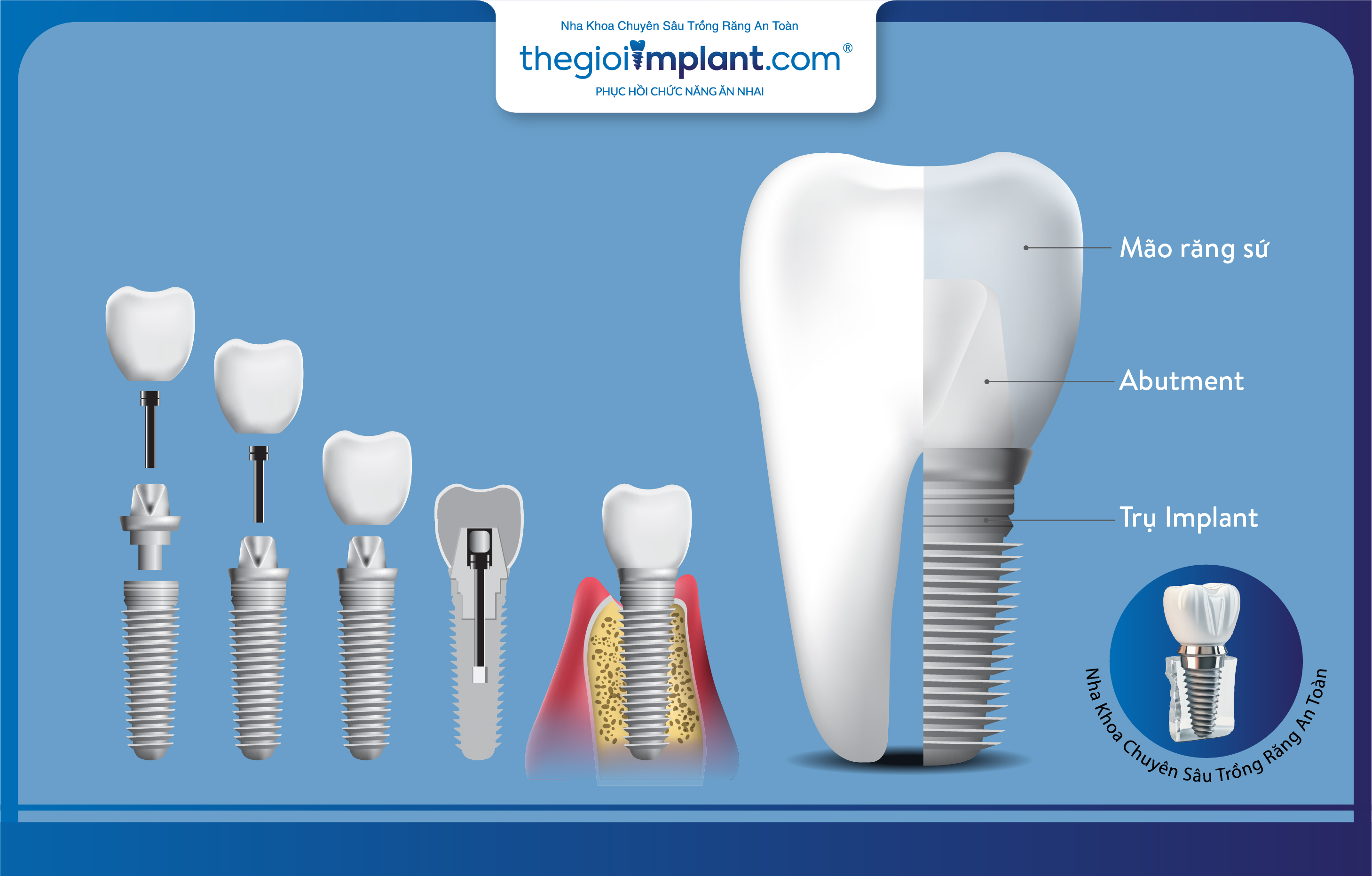 răng Implant