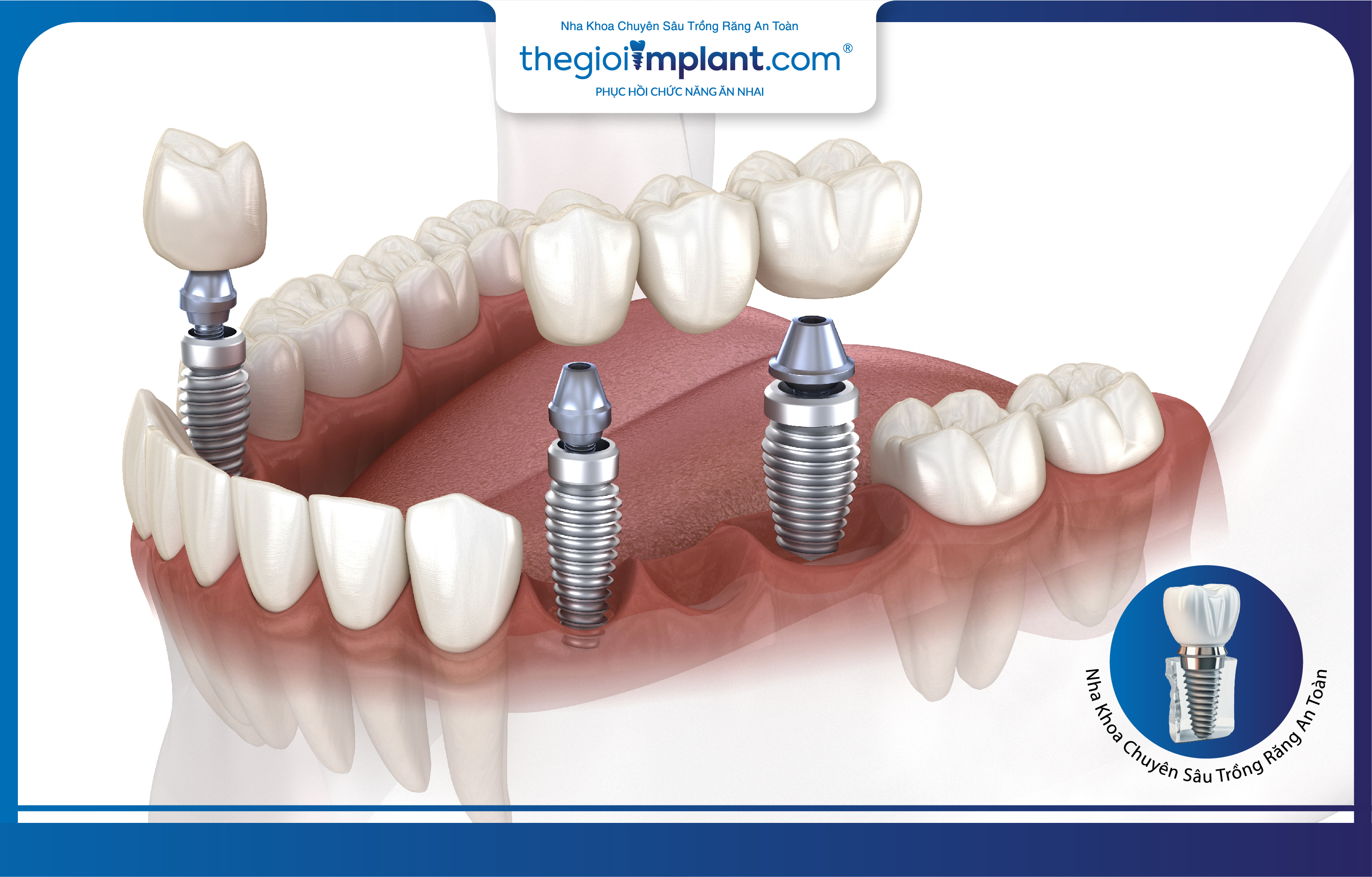 Trồng răng Implant là giải pháp tối ưu để phục hình nhiều răng mất