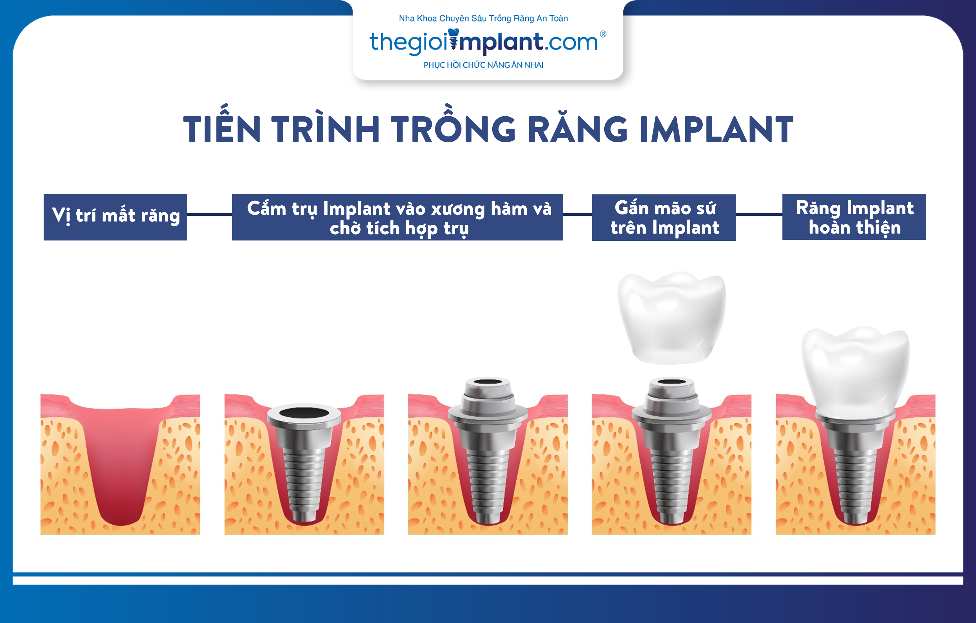 Tiến trình trồng răng Implant phục hình răng mất